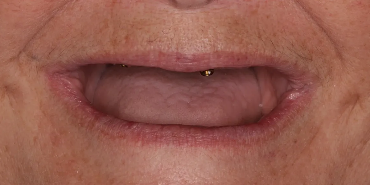 Before treatment: missing upper teeth