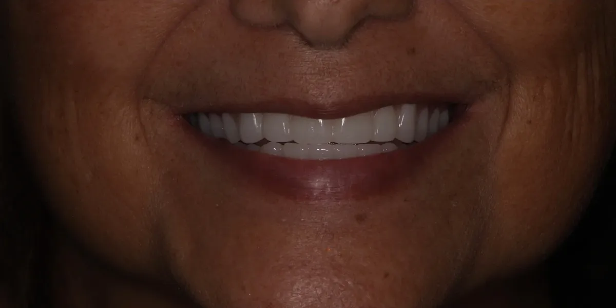 After: bright, even smile