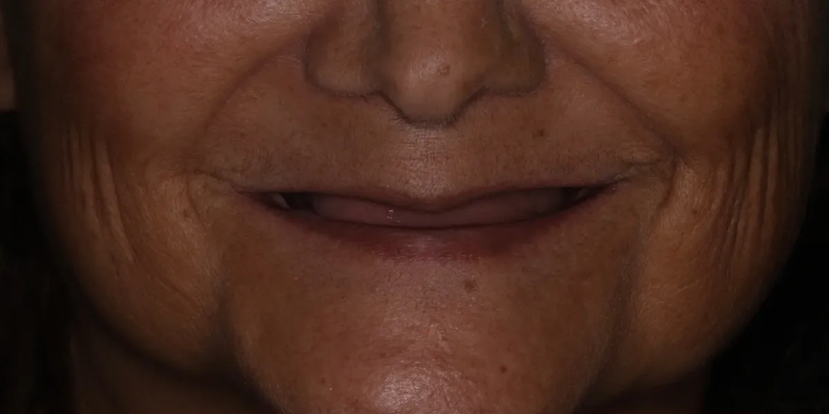 Before: smile with no visible upper teeth