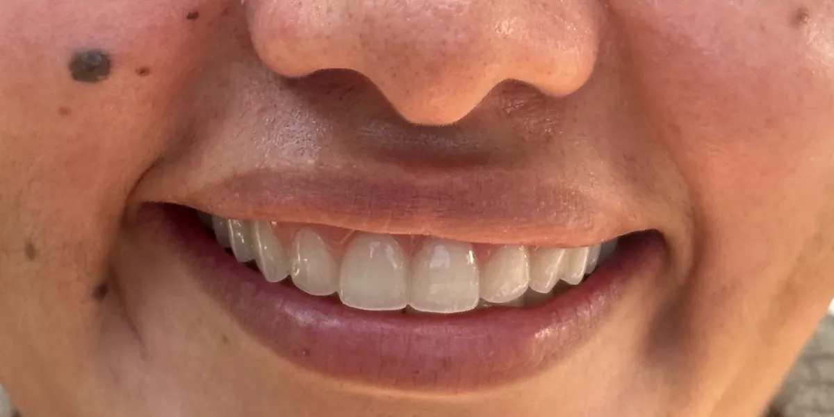 After: complete front teeth