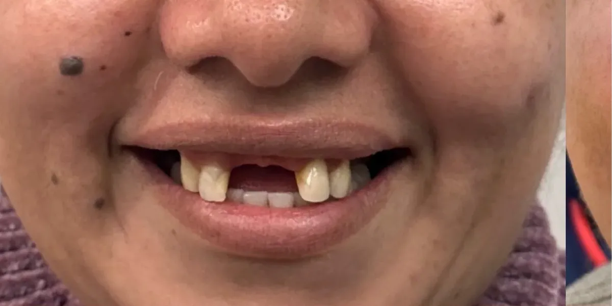Before: gaps from missing front teeth