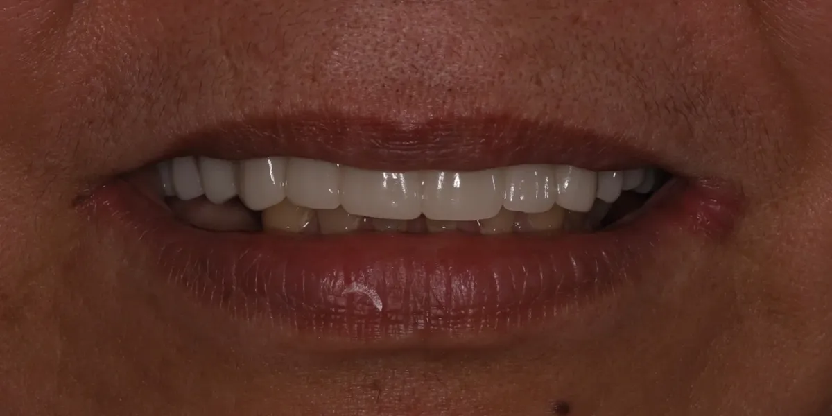 After: full, even smile