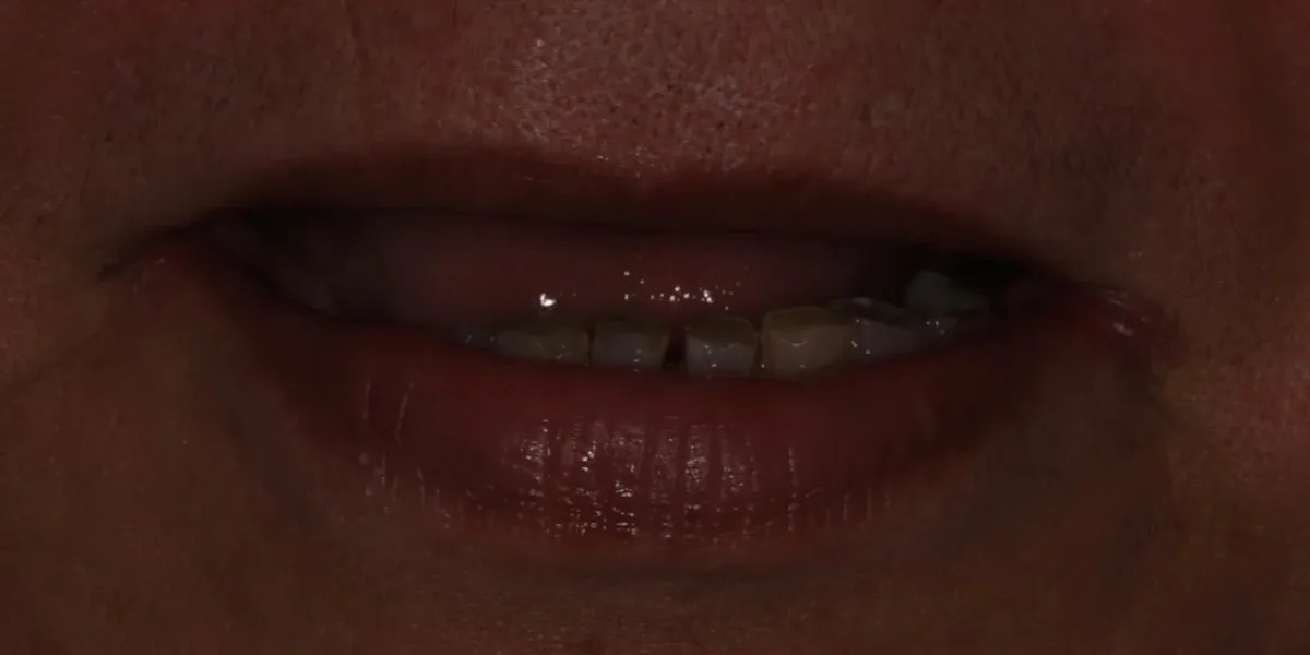Before: worn and missing teeth