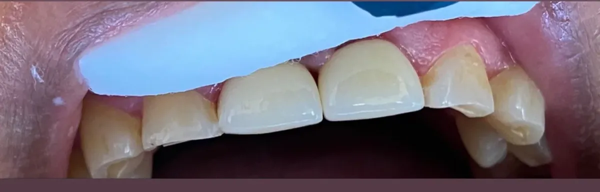 After: restored, evenly shaped teeth