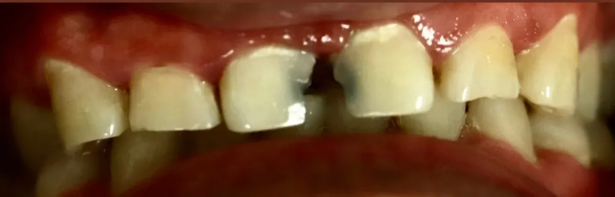 Before: chipped, discolored, and missing teeth