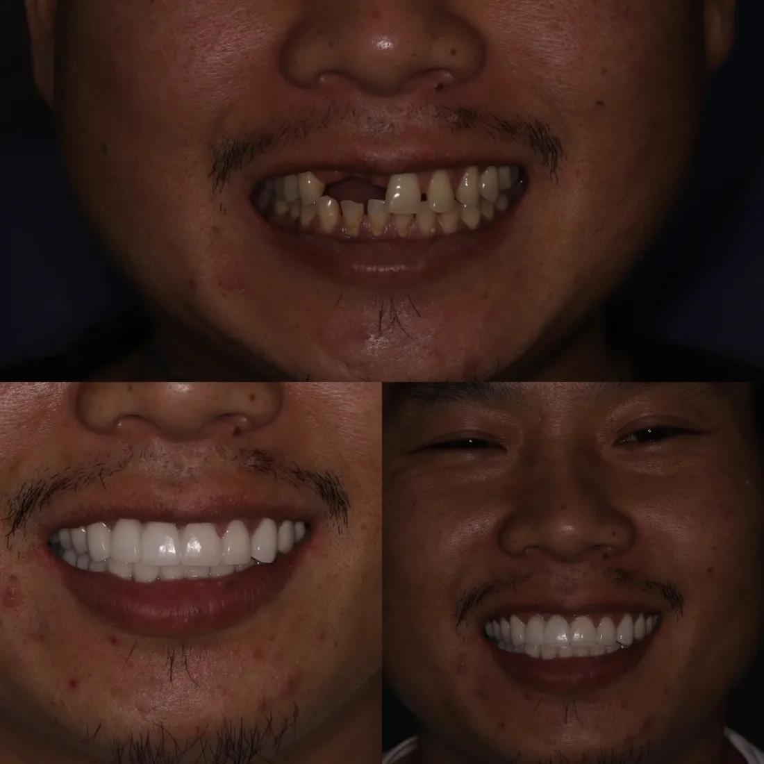 Before (top) and after (bottom) photos of a patient whose missing front teeth were replaced