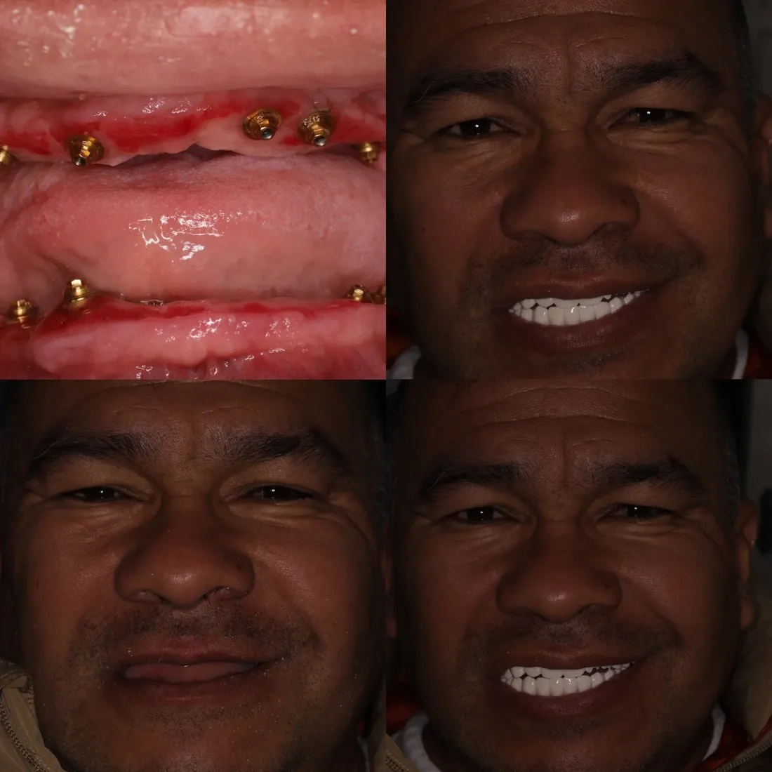 Treatment sequence: implant posts placed, then the patient's finished smile